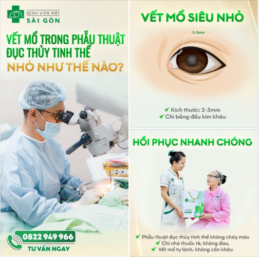 Vết mổ SIÊU NHỎ, chỉ bé như đầu kim khâu; bệnh nhân đục thủy tinh thể an tâm phẫu thuật NHẸ NHÀNG, ÊM ÁI